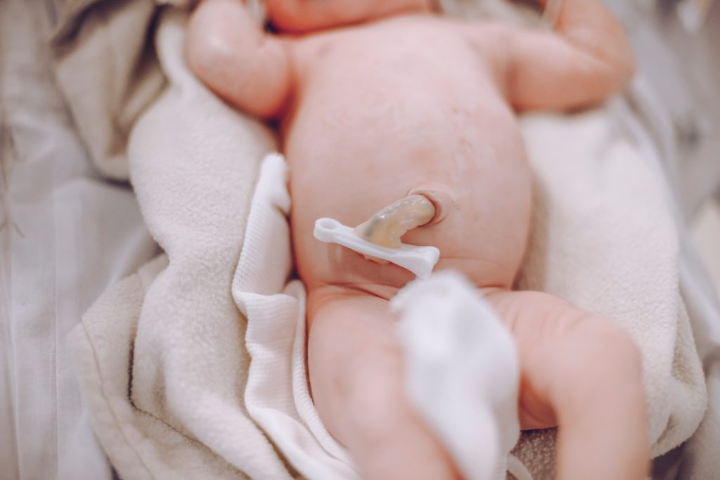 A photograph of a newborn baby's umbilical cord stump